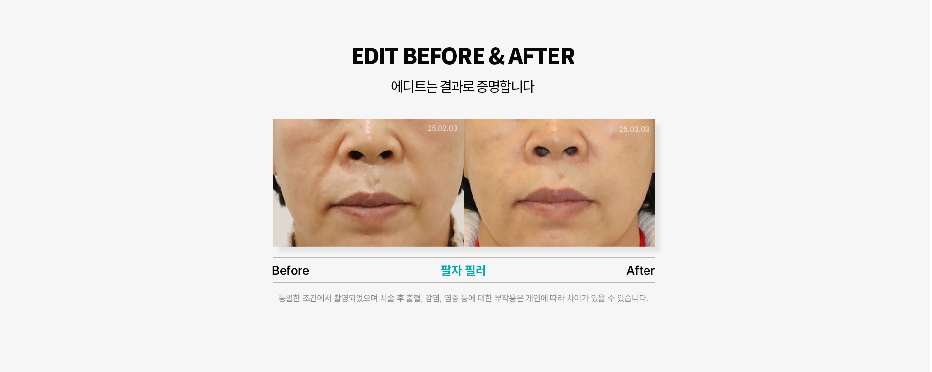 팔자필러 전후사진