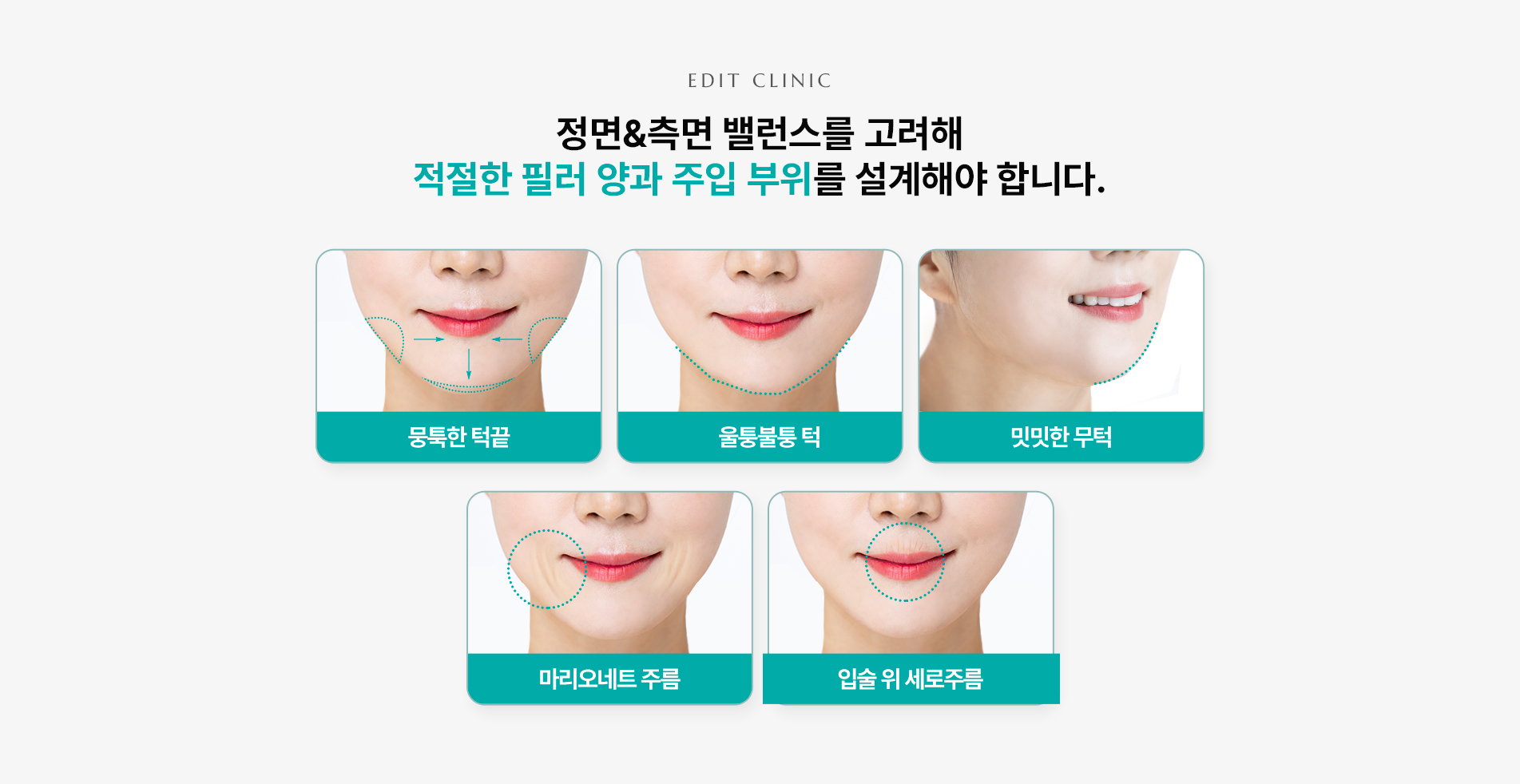 턱끝,마리오네트 부위