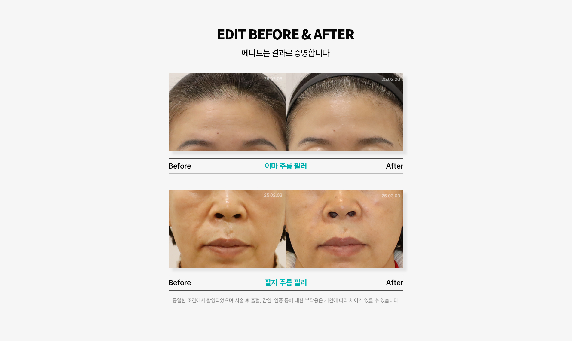 주름필러 전후사진