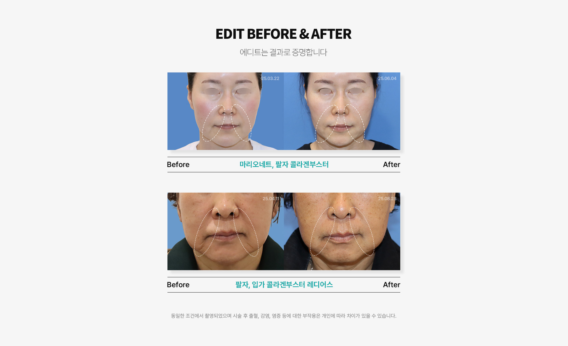 콜라겐리프팅