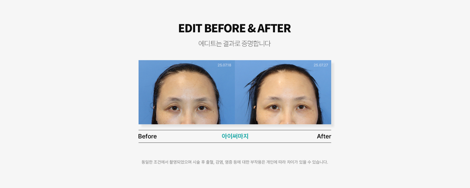 전후사진