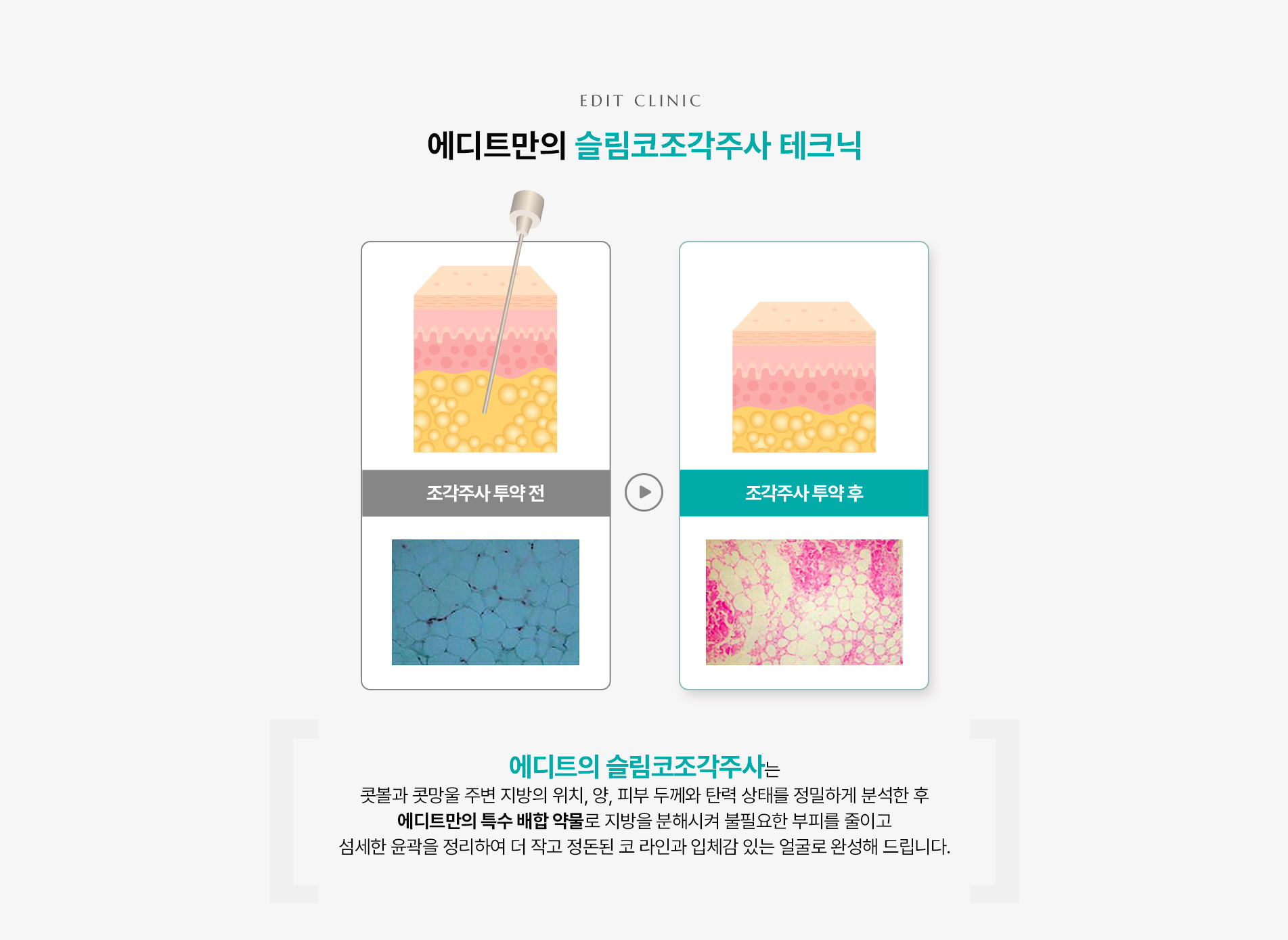 슬림코조각주사